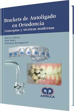 Brackets de Autoligado en Ortodoncia