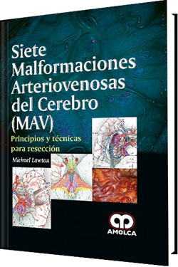 Siete Malformaciones Arteriovenosas del Cerebro (MAV)
