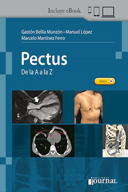 Pectus de la A a la Z